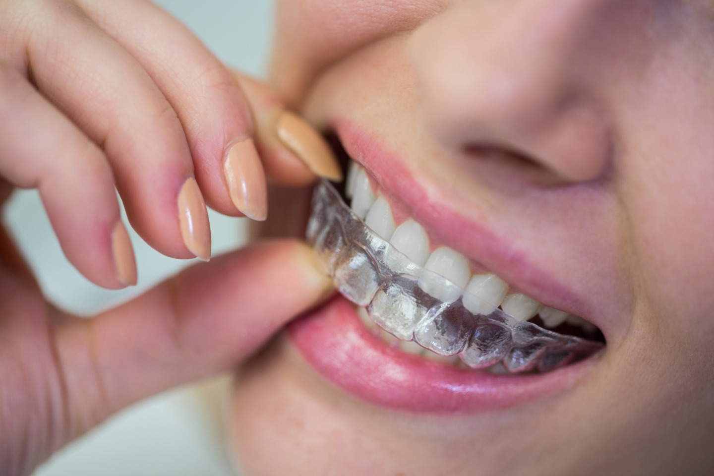 woman-wearing-orthodontic-silicone-invisible-braces (1) (1)