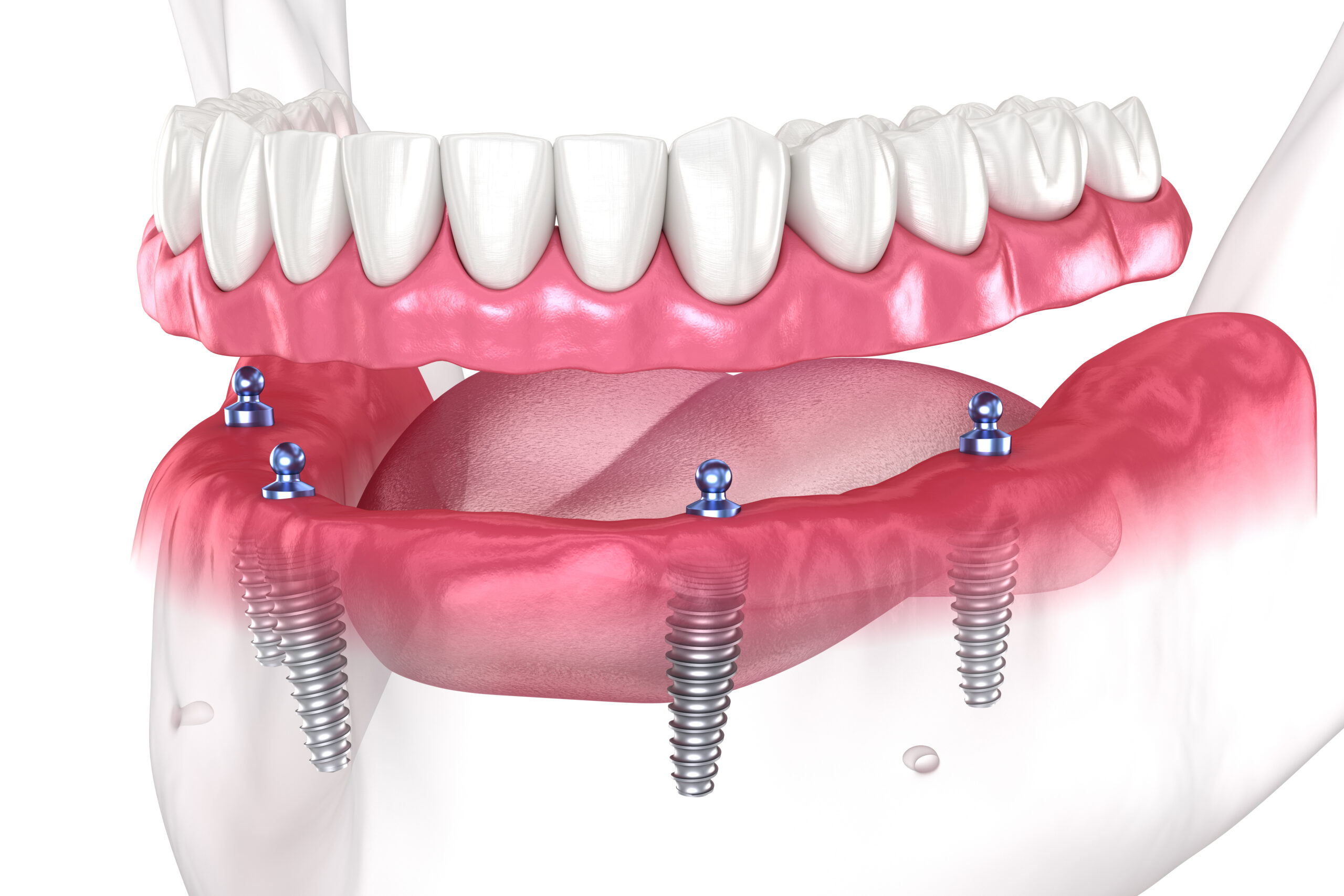 Implant