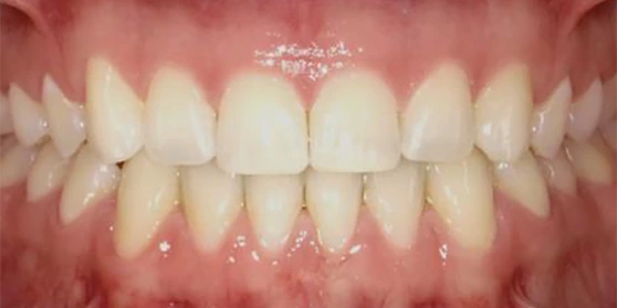 After clear aligner treatment - gaps closed