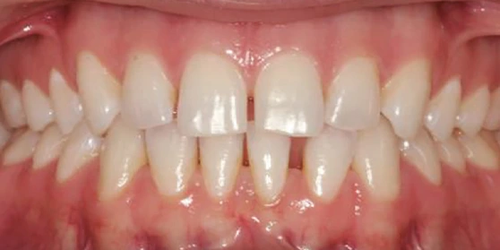 Before clear aligner treatment - gaps between teeth