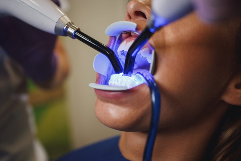 Composite dental restoration cured with a dental light