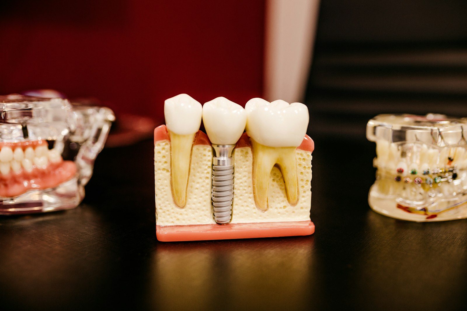Dental implant treatment models