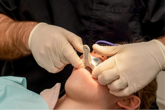 Dental impression being taken for custom dentures
