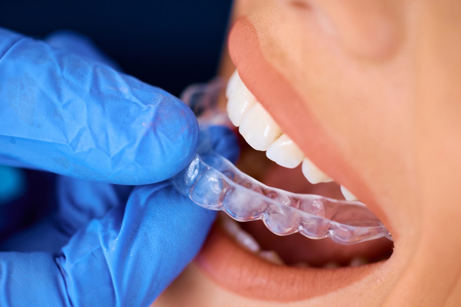 Dentist-supervised SureSmile treatment at Pacific Signature Dental